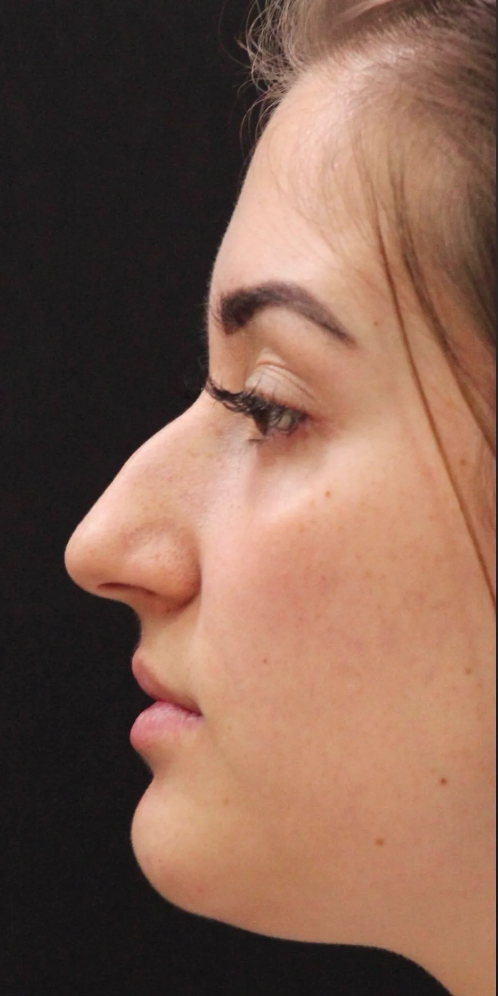 Antes: paciente de perfil
